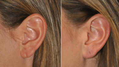 earlobe repair cost