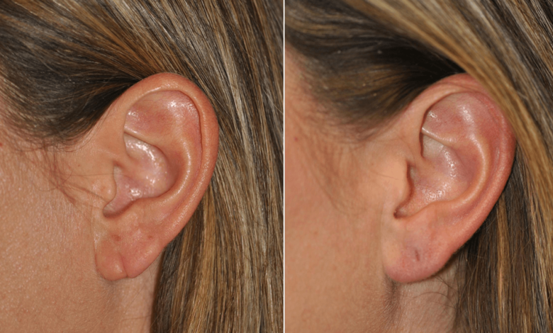 earlobe repair cost